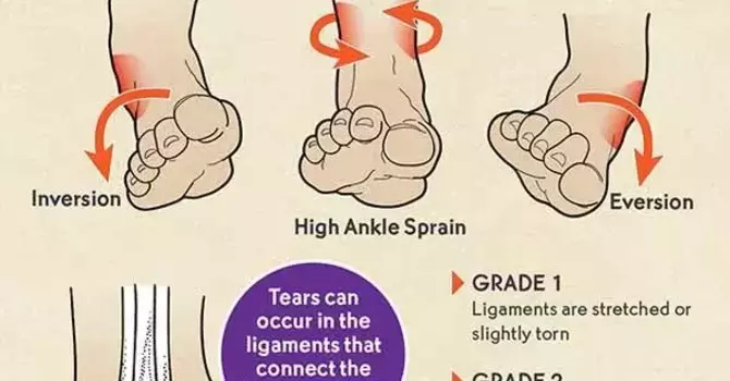 Acute Ankle Sprains Explained: Symptoms, Causes, & Treatment image