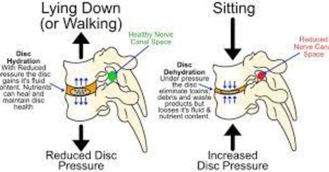 Spinal Discs Go Out Drinking At Night image