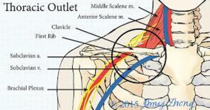 Understanding Thoracic Outlet Syndrome: Expert Advice from Dr. Madeline image