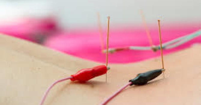 Discover Faster Healing with Acupuncture and Electrical Stimulation! image