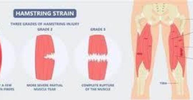 3 Keys to Finally Conquering Lingering Hamstring Pain image